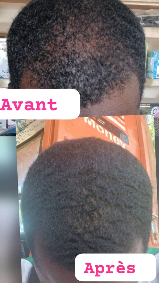 Avant / après : cheveux clairsemés devenus denses