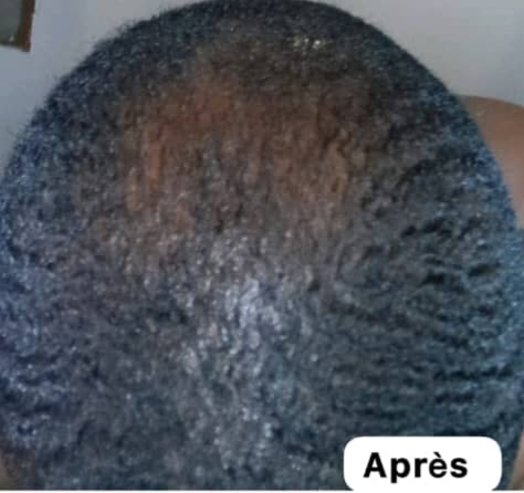 Sommet du crâne, après