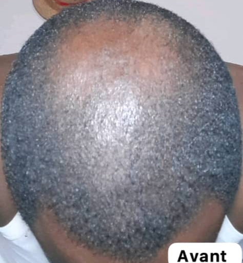Sommet du crâne dégarni, avant